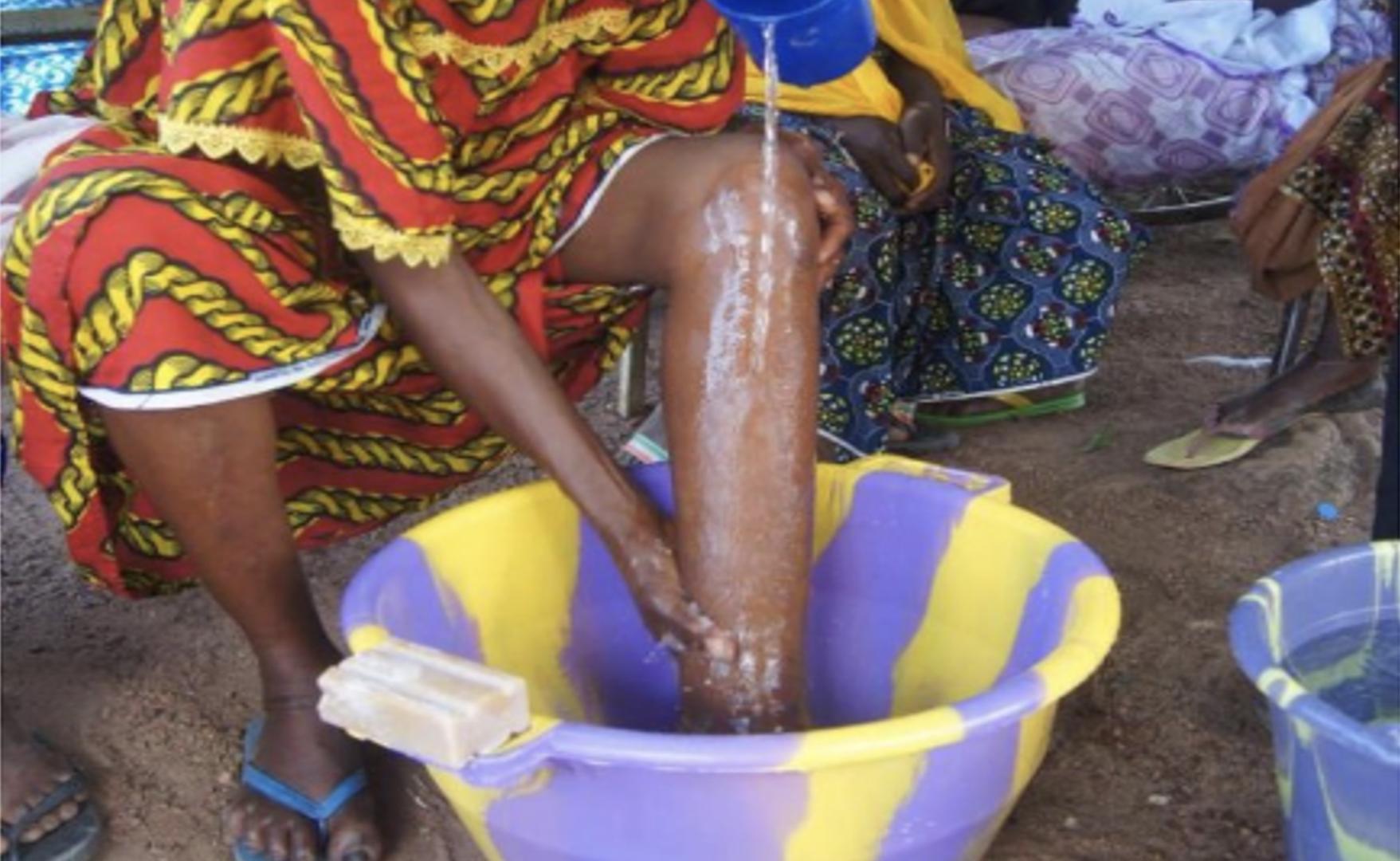 Cameroon on the path to eliminating elephantiasis